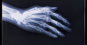 Idaho Hand Injury Lawyers